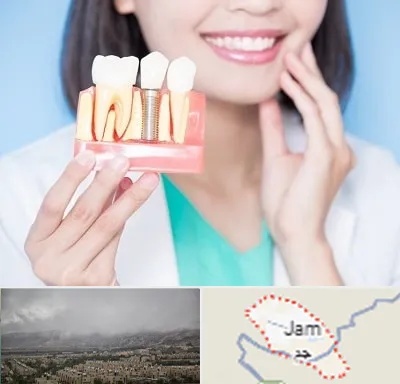 متخصص ایمپلنت در جم