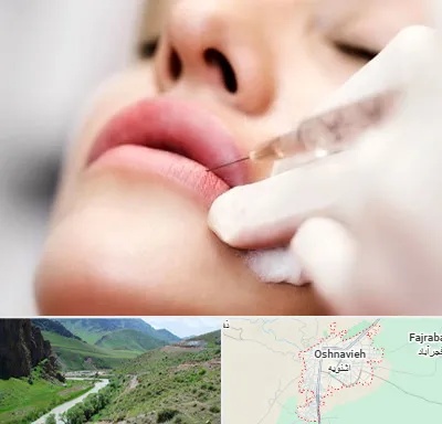 کلینیک تزریق ژل لب در اشنویه