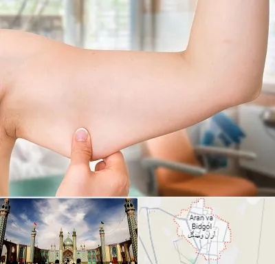 براکیوپلاستی در آران و بیدگل