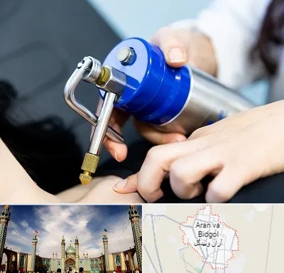کرایوتراپی در آران و بیدگل