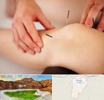 دکتر طب سوزنی برای لاغری در گرمسار