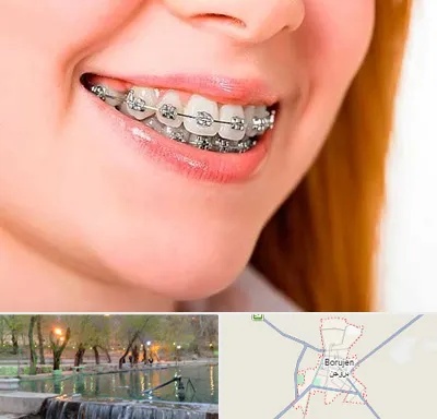 ارتودنسی ارزان در بروجن
