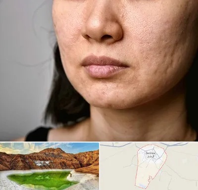 سابسیژن جای جوش در گرمسار