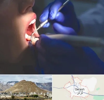 عصب کشی در گراش