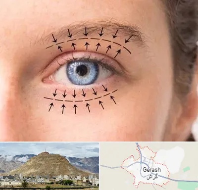 عمل افتادگی پلک در گراش