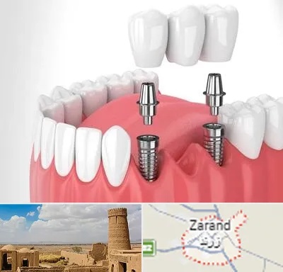کاشت دندان در زرند