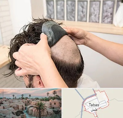پروتز مو در طبس