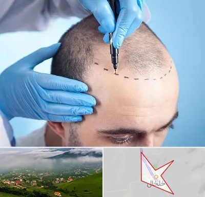 دکتر کاشت مو در خلخال