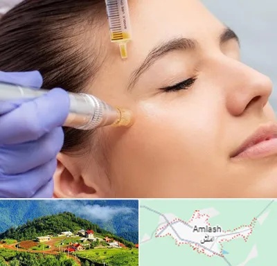 میکرونیدلینگ در املش