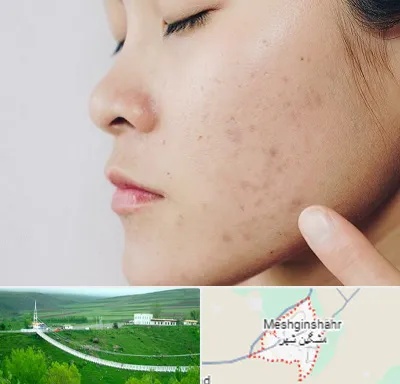 دکتر جوش صورت در مشگین شهر