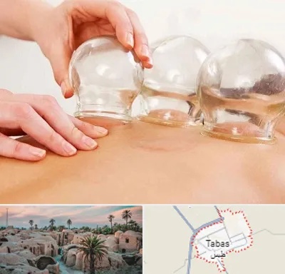 بادکش درمانی در طبس