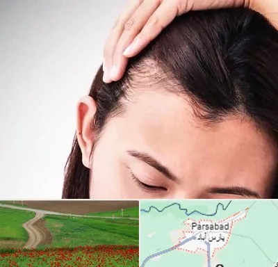 کاشت مو بانوان در پارس آباد