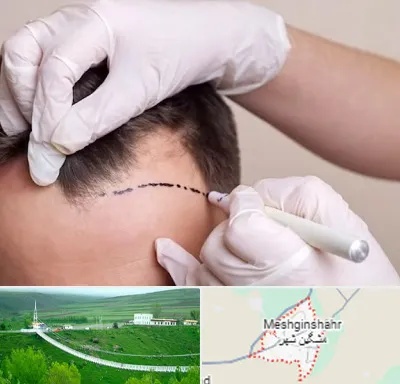 کاشت مو به روش SUT در مشگین شهر