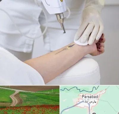 پاک کردن تتو با لیزر در پارس آباد