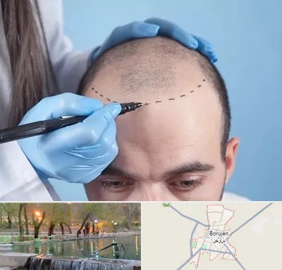 کاشت مو اقساطی در بروجن