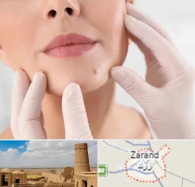 برداشتن خال در زرند