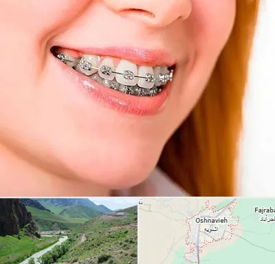 ارتودنسی ارزان در اشنویه