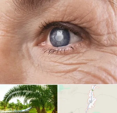 متخصص آب مروارید در کهنوج