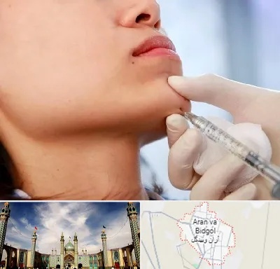 زاویه سازی صورت در آران و بیدگل