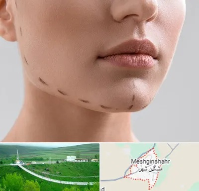 عمل زاویه فک در مشگین شهر
