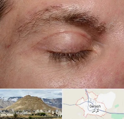 جراح بلفاروپلاستی در گراش