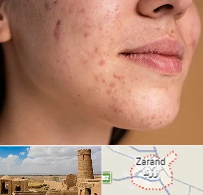 درمان جای جوش در زرند