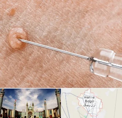 لیزر زگیل تناسلی در آران و بیدگل