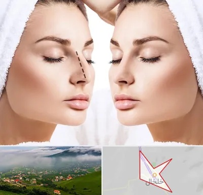 عمل بینی در خلخال