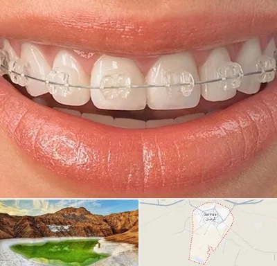 ارتودنسی اقساطی در گرمسار