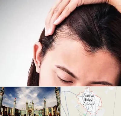کاشت مو بانوان در آران و بیدگل