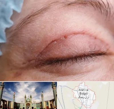 جراح پلک در آران و بیدگل