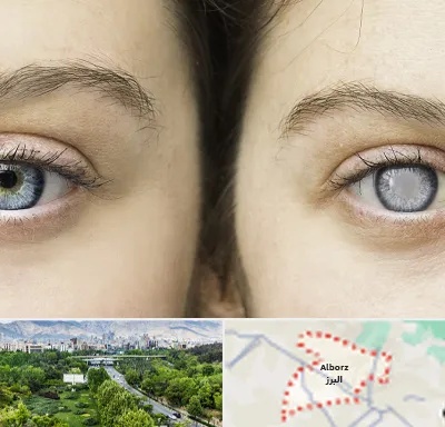 متخصص آب سیاه (گلوکوم) در البرز