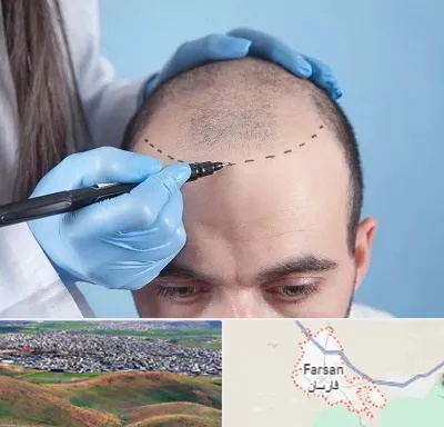 کاشت مو اقساطی در فارسان