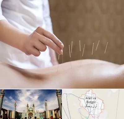 درای نیدلینگ در آران و بیدگل