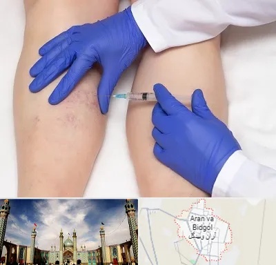 اسکلروتراپی در آران و بیدگل
