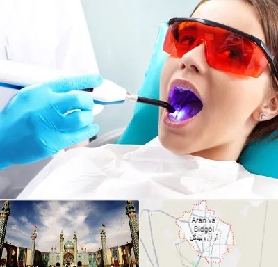 جراحی لثه با لیزر در آران و بیدگل