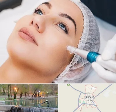 مزونیدلینگ در بروجن