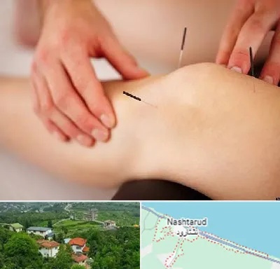 دکتر طب سوزنی برای لاغری در نشتارود