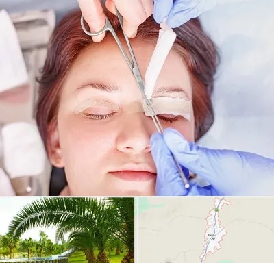 جراحی پلک افتاده در کهنوج