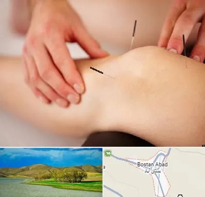 دکتر طب سوزنی برای لاغری در بستان آباد