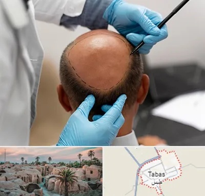 آموزش کاشت مو در طبس