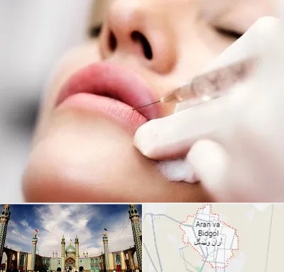 کلینیک تزریق ژل لب در آران و بیدگل