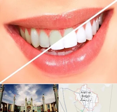 بلیچینگ دندان در آران و بیدگل