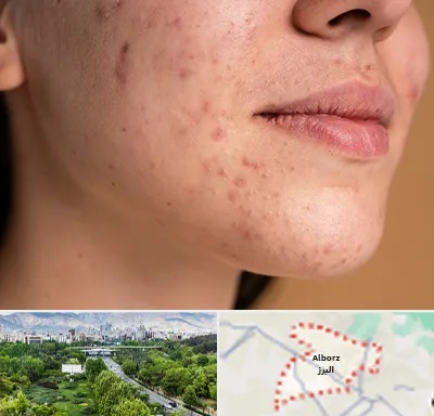 درمان جای جوش در البرز