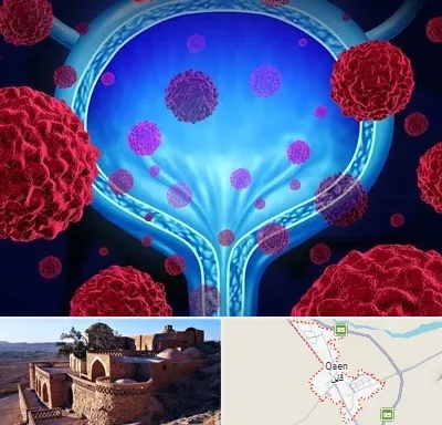 دکتر سرطان مثانه در قائن
