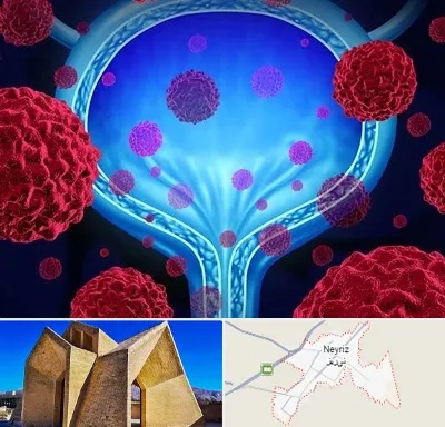 دکتر سرطان مثانه در نی ریز