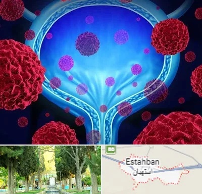 دکتر سرطان مثانه در استهبان