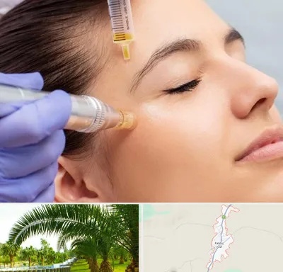 میکرونیدلینگ در کهنوج