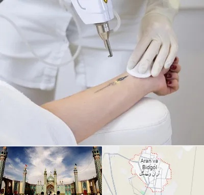 پاک کردن تتو با لیزر در آران و بیدگل