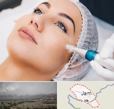مزونیدلینگ در جم